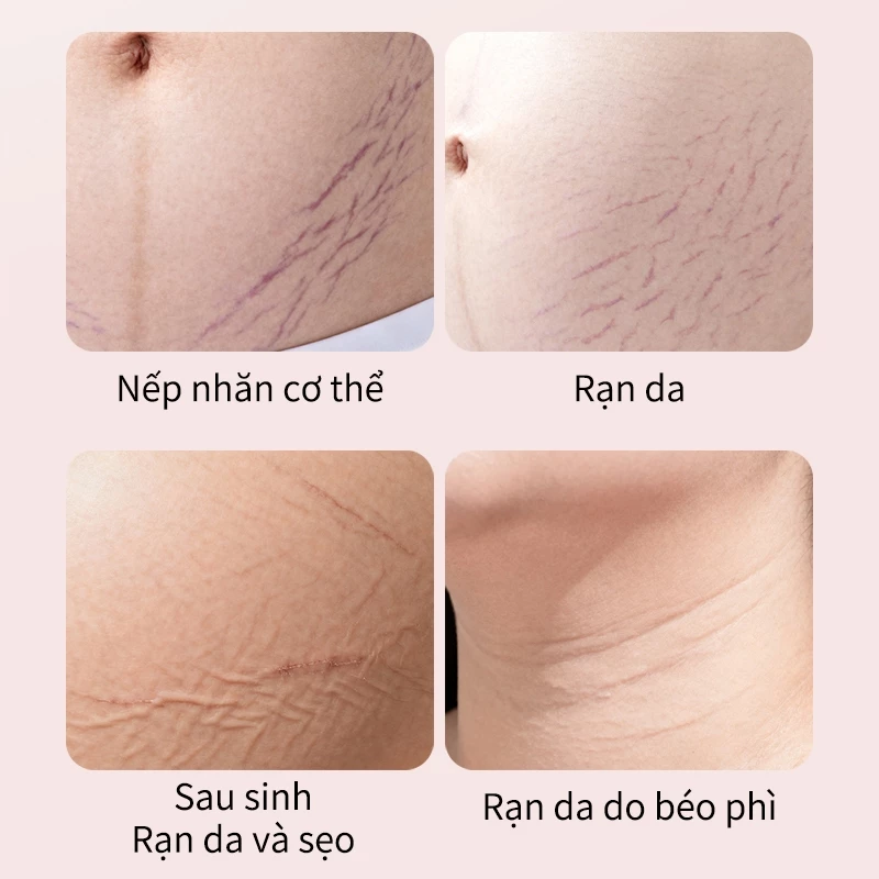 kem rạn da cho bà bầu, kem chống rạn da bà bầu, kem trị rạn da sau sinh, kem dưỡng da bà bầu, kem dưỡng ẩm cho mẹ bầu, kem ngừa rạn bụng bầu