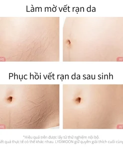 kem rạn da cho bà bầu, kem chống rạn da bà bầu, kem trị rạn da sau sinh, kem dưỡng da bà bầu, kem dưỡng ẩm cho mẹ bầu, kem ngừa rạn bụng bầu