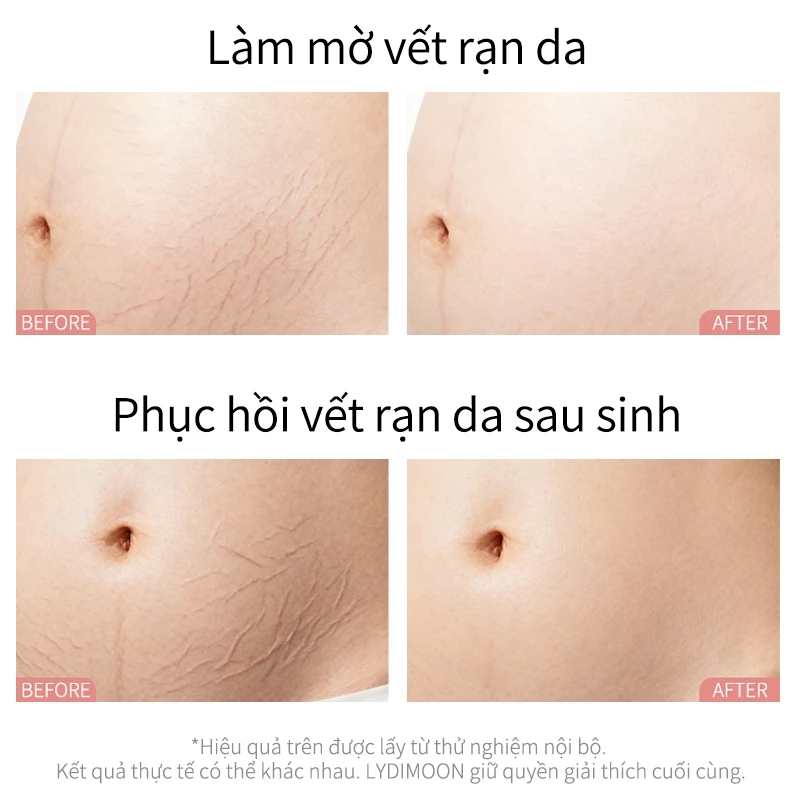kem rạn da cho bà bầu, kem chống rạn da bà bầu, kem trị rạn da sau sinh, kem dưỡng da bà bầu, kem dưỡng ẩm cho mẹ bầu, kem ngừa rạn bụng bầu